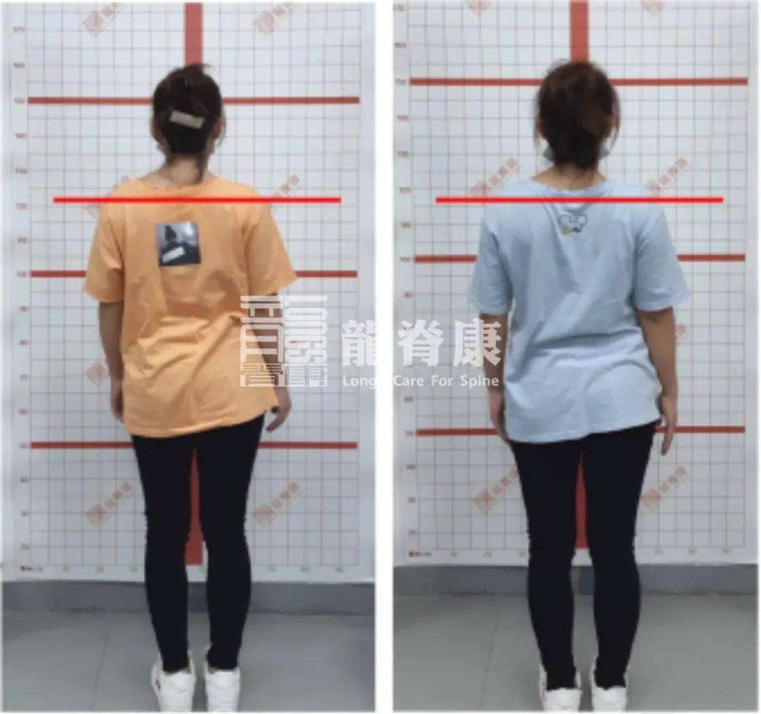 milan米兰app官网：
稀有病例：成人侧弯伴右胸廓肋骨畸形导致的崎岖肩 如何改善？(图4)
